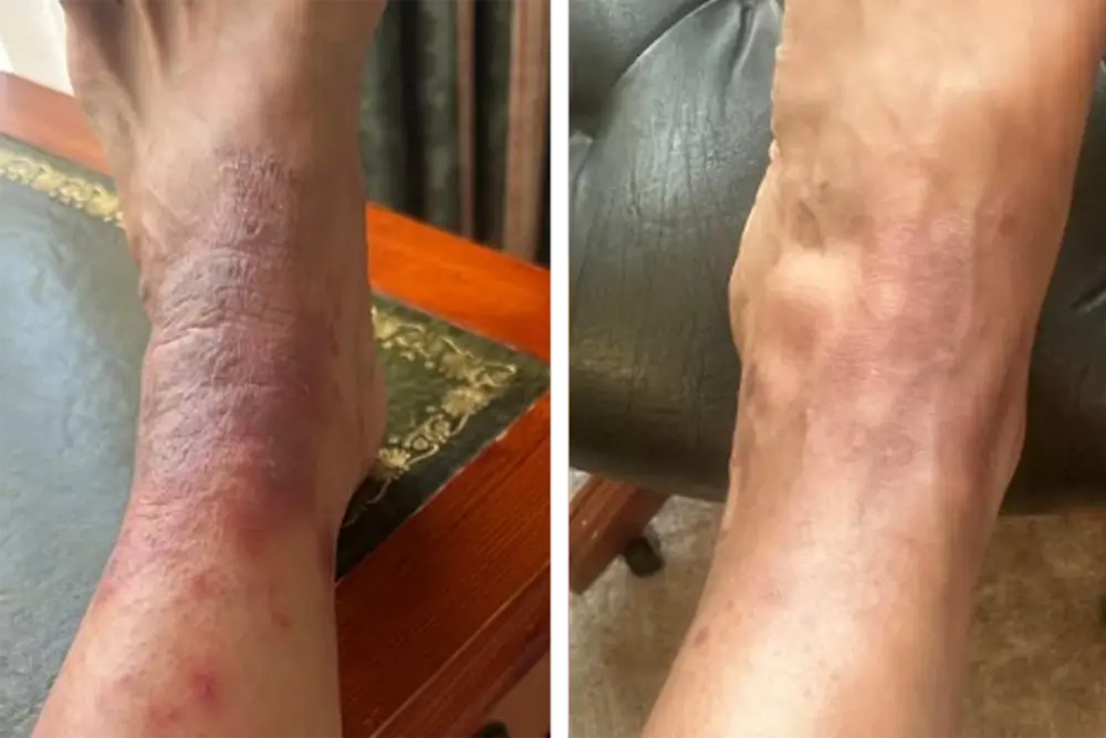Skin Rash Treatment Skin Rash Treatment