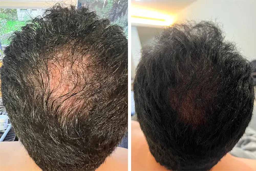 Hair Loss Treatment Before & After Hair Loss Treatment Before & After