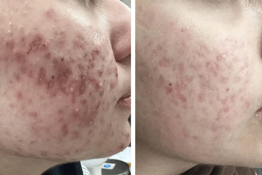 Sever Acne Treatment & Management Sever Acne Treatment & Management