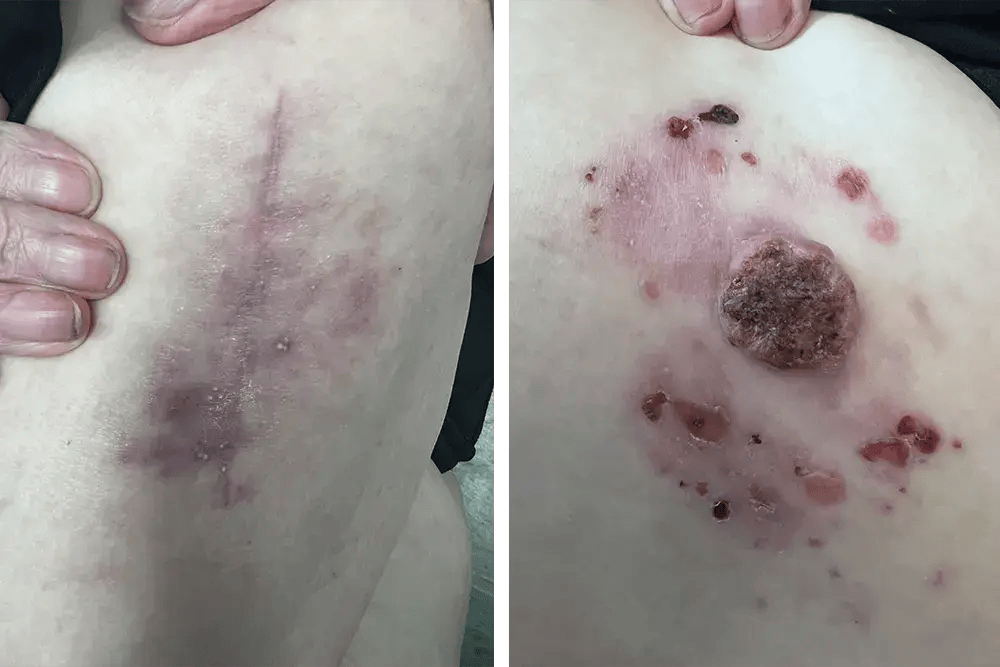 Skin Cancer Tumor Removal Skin Cancer Tumor Removal