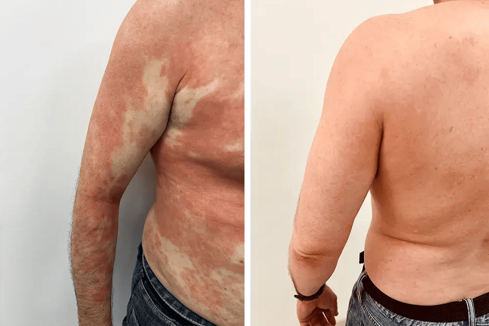 Skin Rash Treatment Skin Rash Treatment