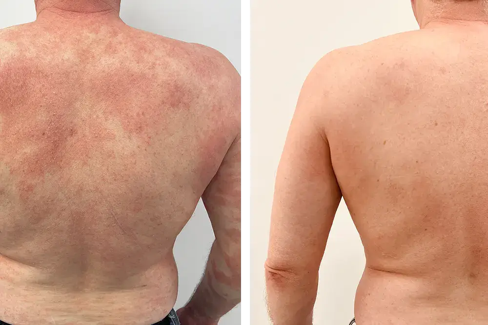 Skin Rash Treatment Skin Rash Treatment