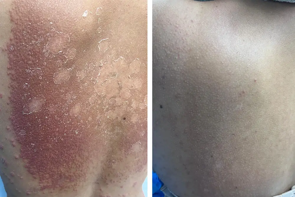 Skin Rash Treatment Skin Rash Treatment