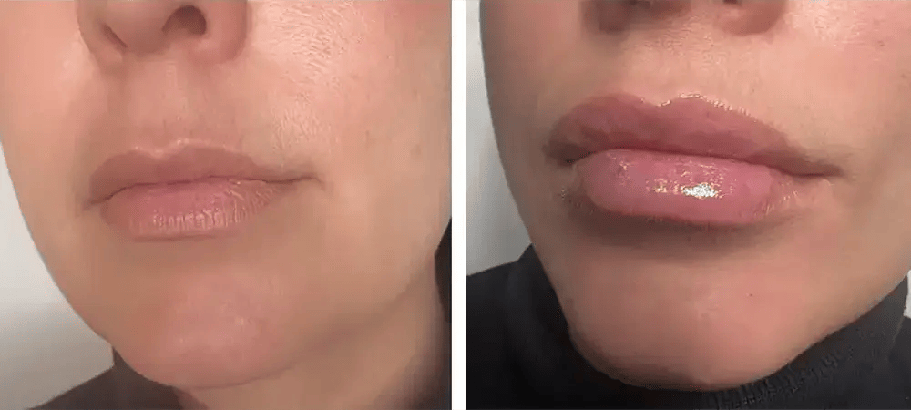 Lip Fillers Before & After Lip Fillers Before & After